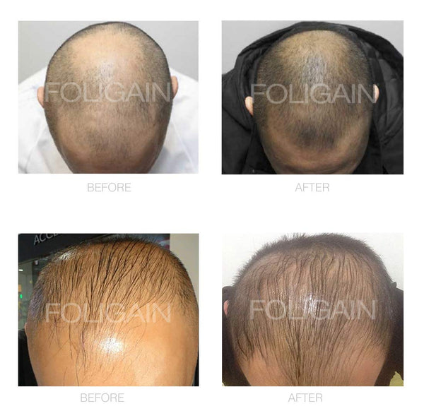 FOLIGAIN Minoxidil 5% Hair Regrowth Foam For Men 6 Month Supply - FOLIGAIN UK