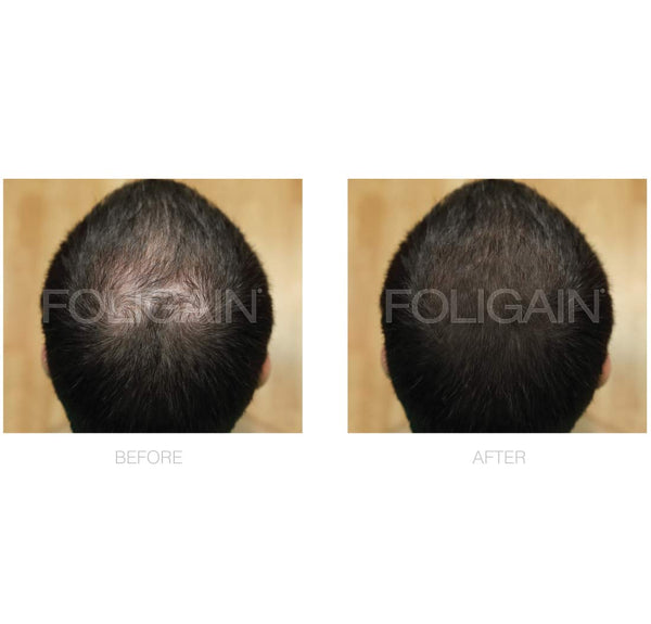 FOLIGAIN Advanced Hair Regrowth Treatment Foam For Men with Minoxidil 5% - FOLIGAIN UK